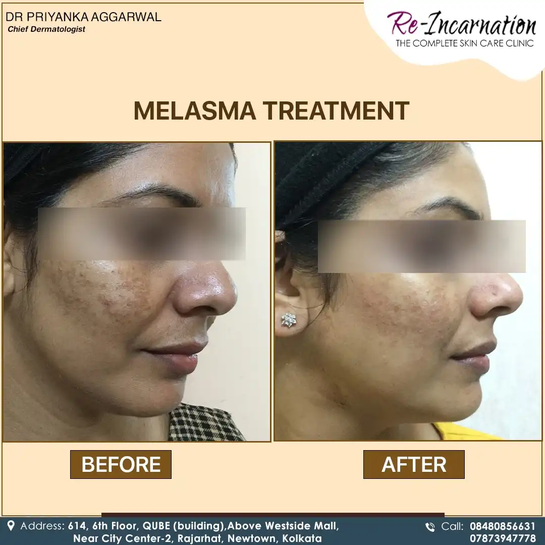 Find the Dermatologists in Kolkata - Before and After Result