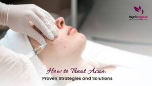 Read more about the article How to Treat Acne: Proven Strategies and Solutions