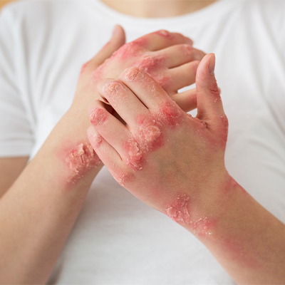 eczema