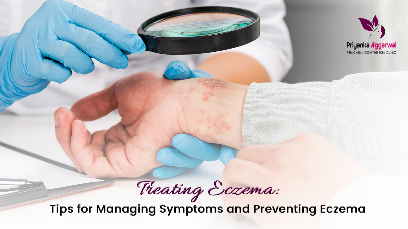 You are currently viewing Treating Eczema: Tips for Managing Symptoms and Preventing Eczema