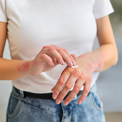 eczema