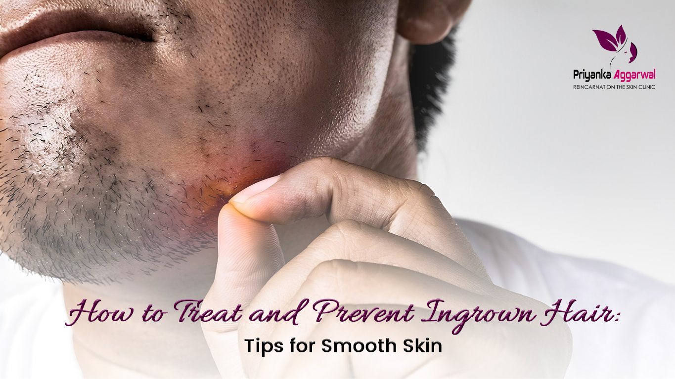 Read more about the article How to Treat and Prevent Ingrown Hair: Tips for Smooth Skin