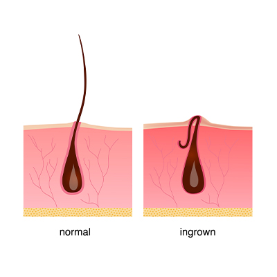 Prevent Ingrown Hair